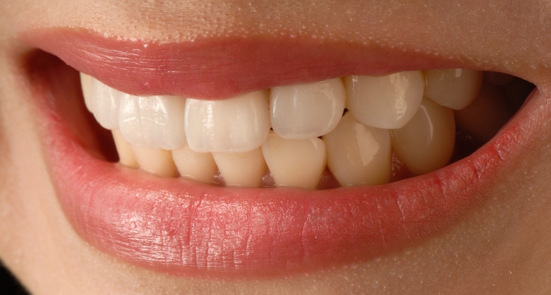 Λεύκανση δοντιών: όλα όσα πρέπει να ξέρουμε